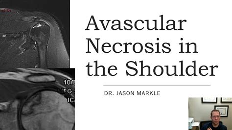 Avn Avascular Necrosis Shoulder Youtube
