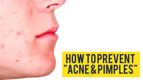 How To Prevent Acne And Pimples Recipe Masala Tv