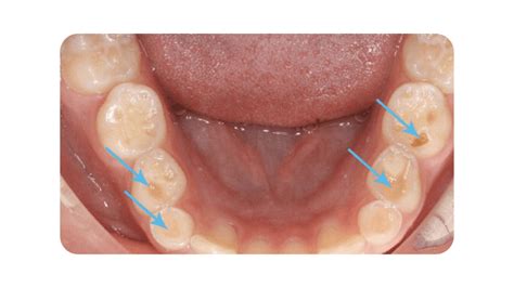 Bruxism Grinding Your Teeth Summerlin Dental Solutions