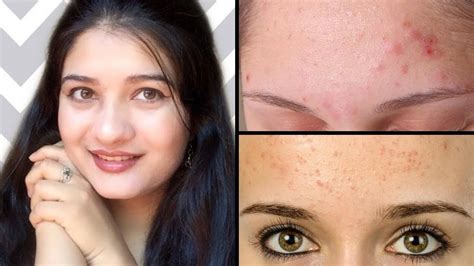 How To Get Rid Of Small Acne Bumps On Face Overnight Mang Temon