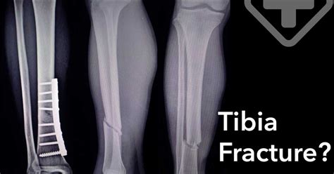 Tibia Fracture Causes Symptoms Diagnosis And Treatment