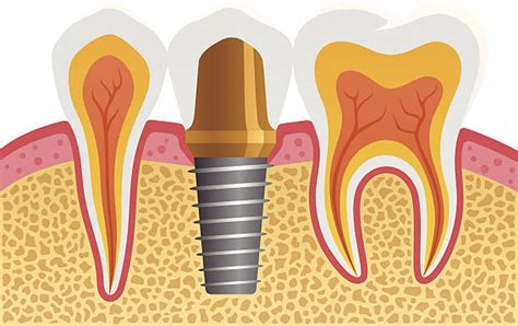 Royalty Free Dental Implant Clip Art Vector Images And Illustrations