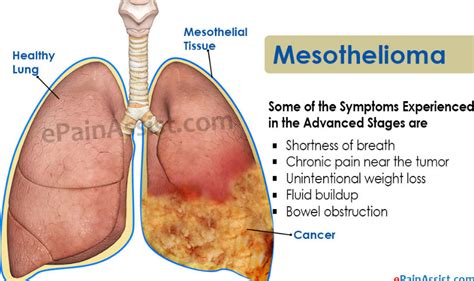 Mesothelioma Cancer Symptoms Of Mesothelioma Cancer Readnews