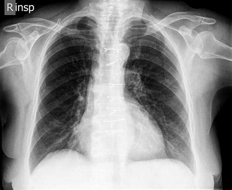 Normal Chest X-ray Photograph by Photostock-israel | Fine Art America