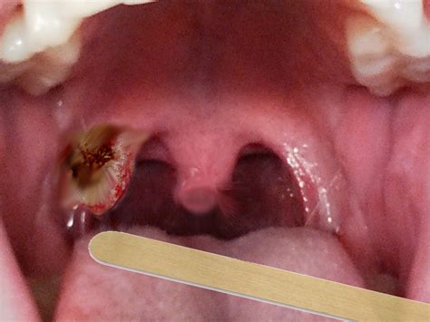 Tonsil Cancer Article