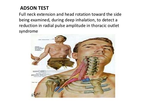 Adson Testfull Neck Extension And Head Rotation Toward The Sidebeing