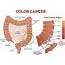Do You Know That Colorectal Cancer Is The Third Most Common In 