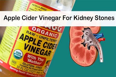 Apple Cider Vinegar For Kidney Stones Wellnessguide
