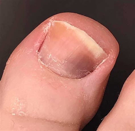 Picture Of Melanoma Under Big Toenail Share News About Nail