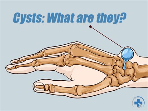 What Are Cysts And When Should You Be Concerned Path 411 Pain