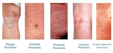 Satyug Health Care Psoriasis Symptoms And Treatment Cost Of