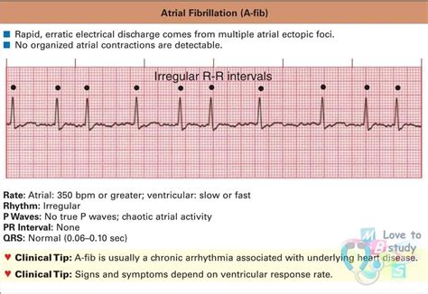 The P Wave On An Ecg Represents