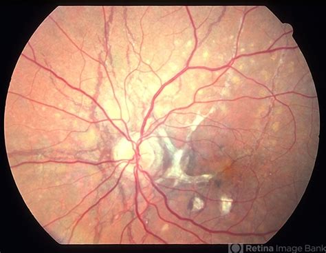 Angioid Streaks Pxe Retina Image Bank