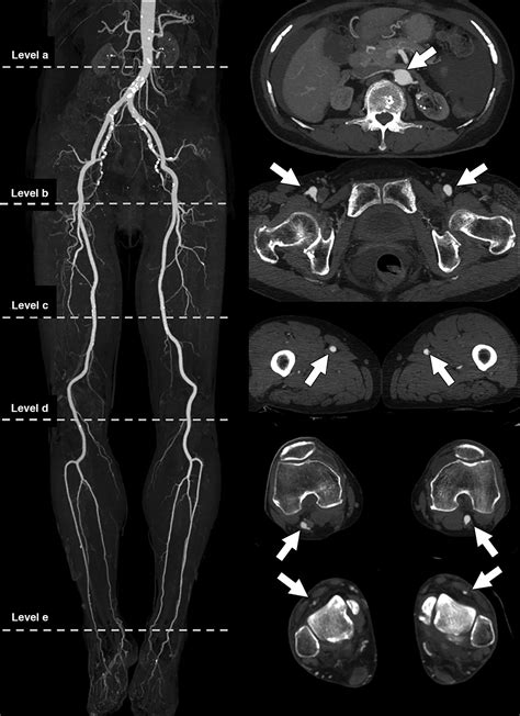 Ct Angiography Of Suspected Peripheral Artery Disease Comparison Of