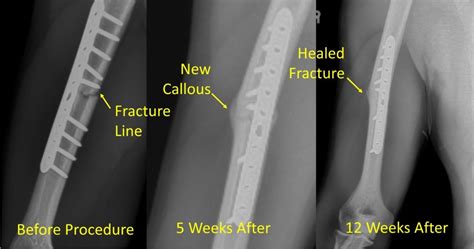 Bone Marrow Concentrate And Non Union Fractures Regenexx