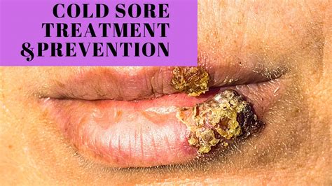 Cold Sore Prevention And Treatment Youtube