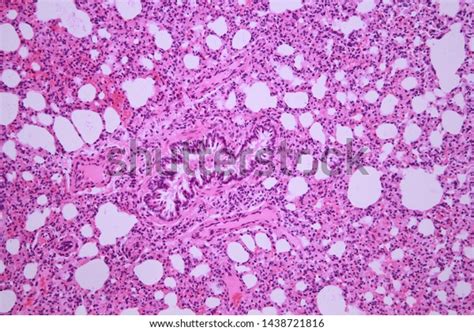 Crosssection Lung Tissue Showing Fragment Bronchiole Stock Photo
