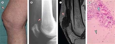 Gouty Tophus In The Quadriceps Tendon Exclude Malignancy The Lancet