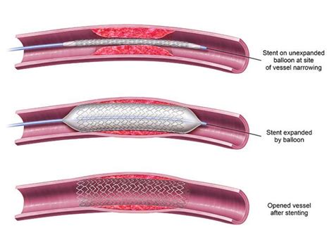 angioplasty and stent placement procedures azura vascular care