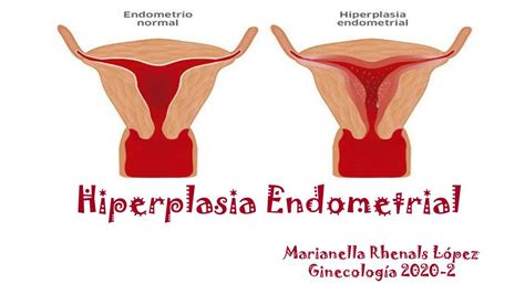 Hipersalpisa Endometrial Marianella Rhenals Udocz