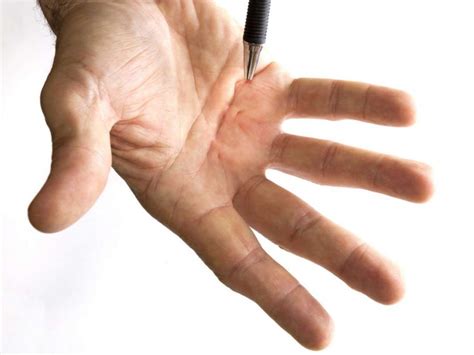 Dupuytrens Contracture Symptom Causes And Ultimate Top 6 Risk Factor