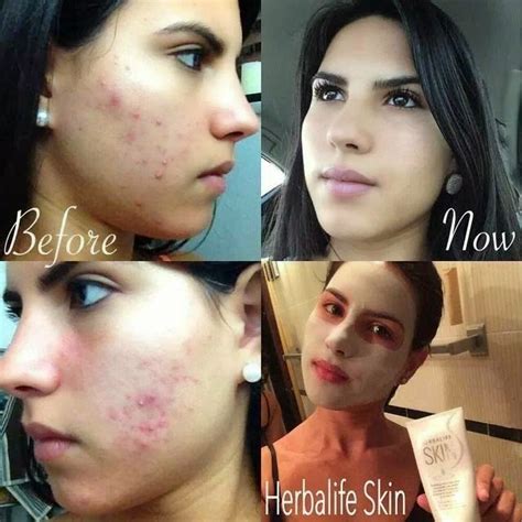 Herbalife skin care before and after. SKIN CARE HERBALIFE INDEPENDENT ASSOCIATE : Results of ...