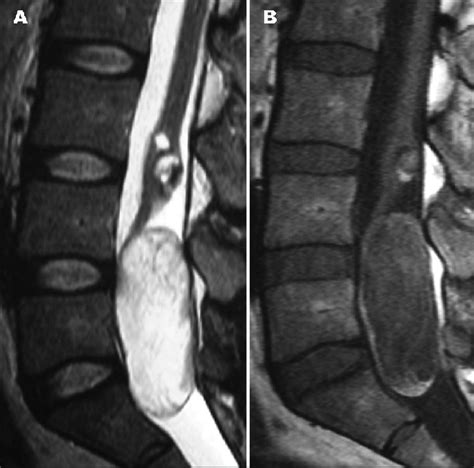 Mri Sagittal Sections A T2 Weighted And B T1 Weighted Sequences