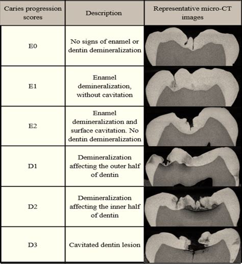 Caries Progression Scores Attributed To The Specimens After Micro CT