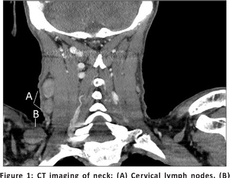 Figure 1 From Cervical Syphilitic Lymphadenitis Causing Fever Of