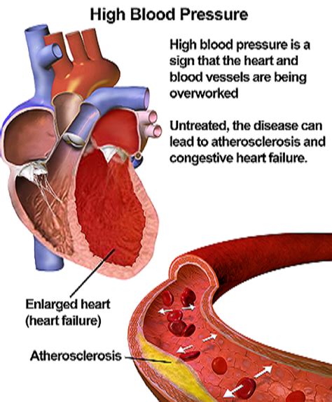 High Blood Pressure: Symptoms, Causes & Remedies - Biology Class [2021] | Study.com