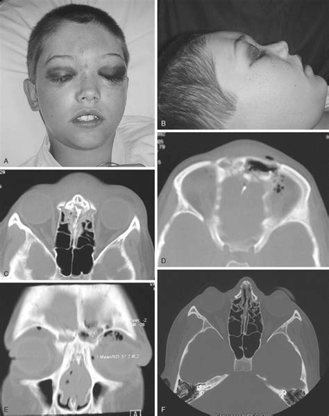 Cranio Maxillofacial Injuries In Children Pocket Dentistry