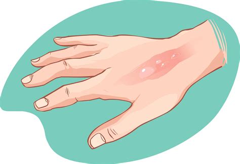 How To Treat A Burn Complete Howto Wikies