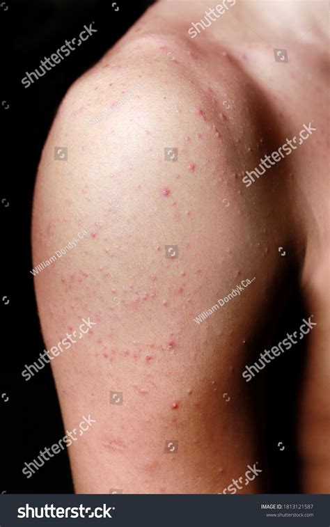 Detail Arm Acne On Skin Stock Photo 1813121587 Shutterstock