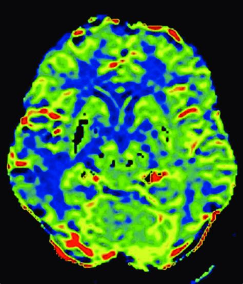 Perfusion Weighted Imaging Pwi Study Presence Of Low Cerebral Blood