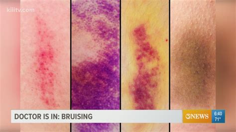 your bruises tell a story about your body and the best way to treat the nasty and sometimes