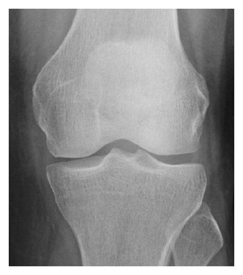 Proximal Metaphyseal Fatigue Fracture Of The Tibia In A 27 Year Old