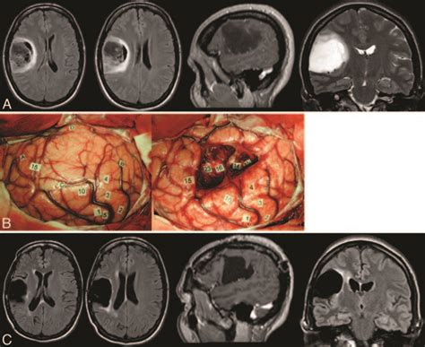 Surgery For Low Grade Glioma Infiltrating The Central Cerebral Region