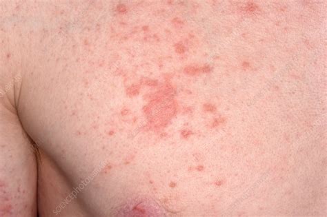Eczema Stock Image C0381549 Science Photo Library
