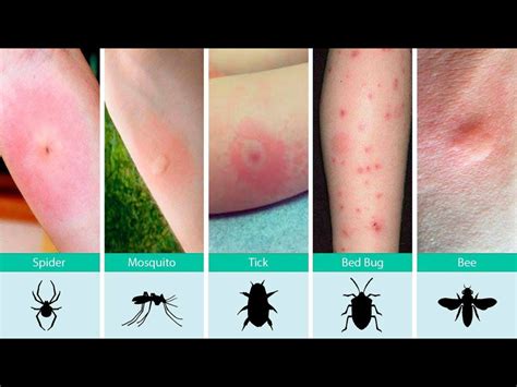 Cool Flea Vs Bed Bug Bite Images References