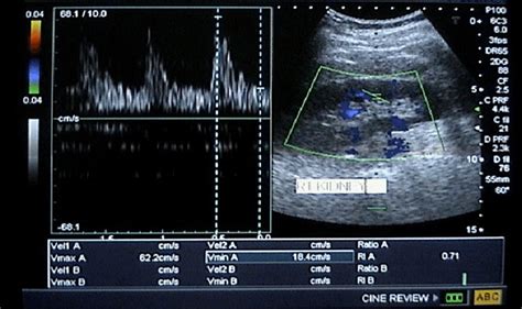 Doppler Sonography Of The Right Kidney Showing Increased Renal