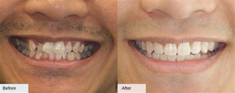 Invisalign Before And After Cases You Need To See