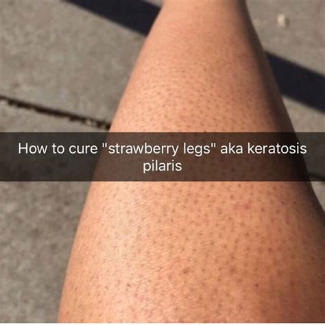 How To Exfoliate Legs With Ingrown Hairs