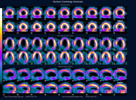 Top tid abbreviation meanings updated march 2021. Gallery | Nuclear Cardiology Seminars