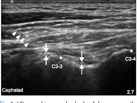 Pdf Ultrasound Guided Pulsed Radiofrequency Of The Third Occipital