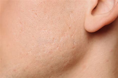 Acne Scars On The Face Stock Photo Image Of Melanoma 180489814