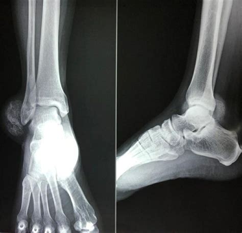 Primary Synovial Osteochondromatosis Of Ankle In An Adult Male Patient