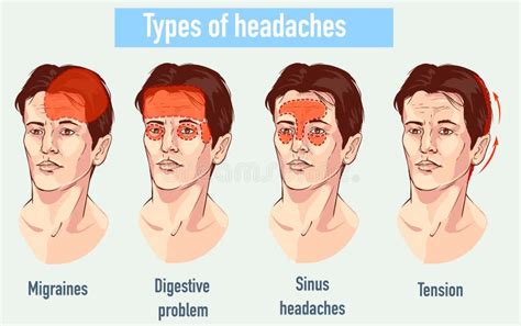 Illustration About Headaches 4 Type On Different Area Of Patient Stock