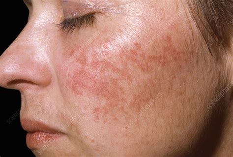 Acne Rosacea Stock Image C0500875 Science Photo Library