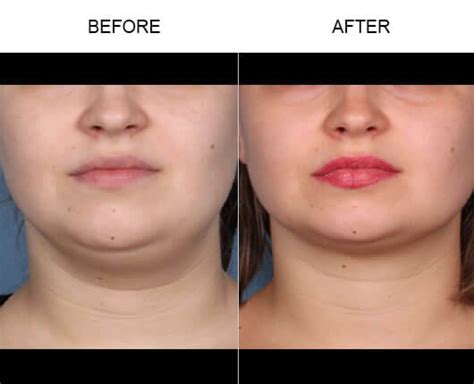 Kybella Orlando Double Chin Treatment