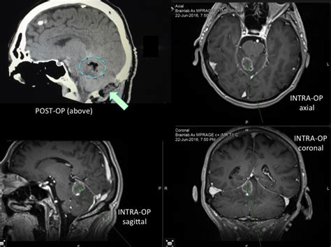 Brain Tumor Surgery Brain Cancer Surgery Minimally Invasive Surgery